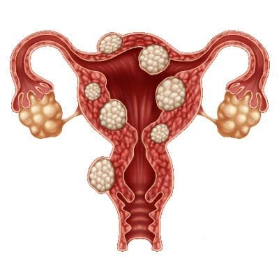 adakah fibroid sejenis kanser