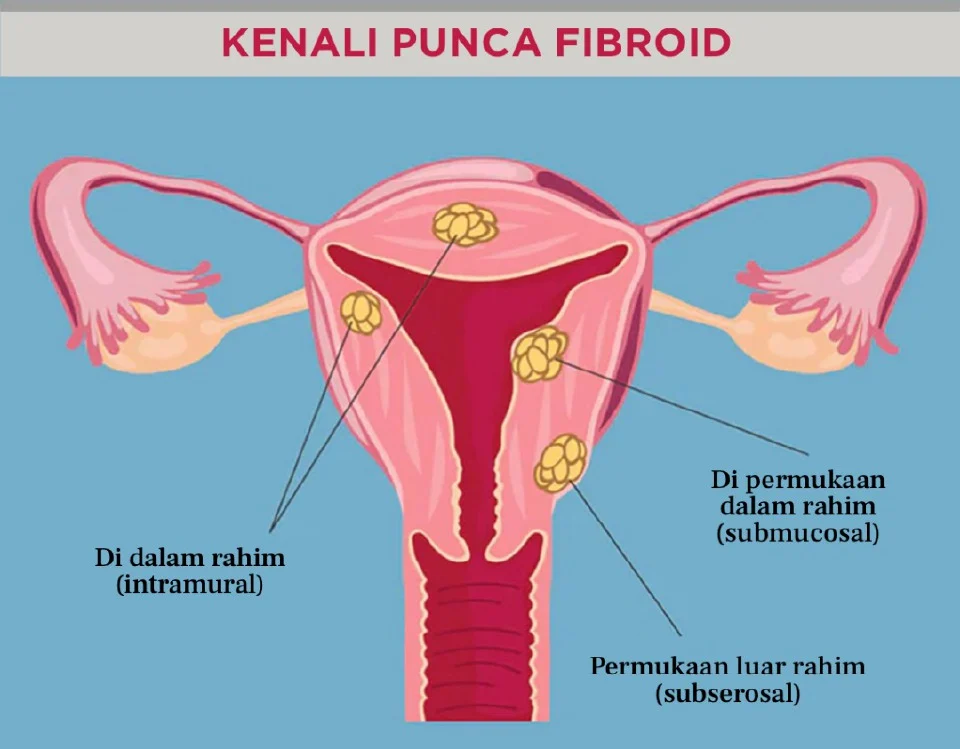 kenali punca fibroid